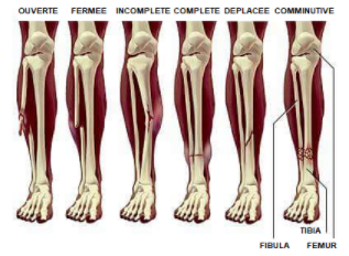 Fracture du tibia – Uperform